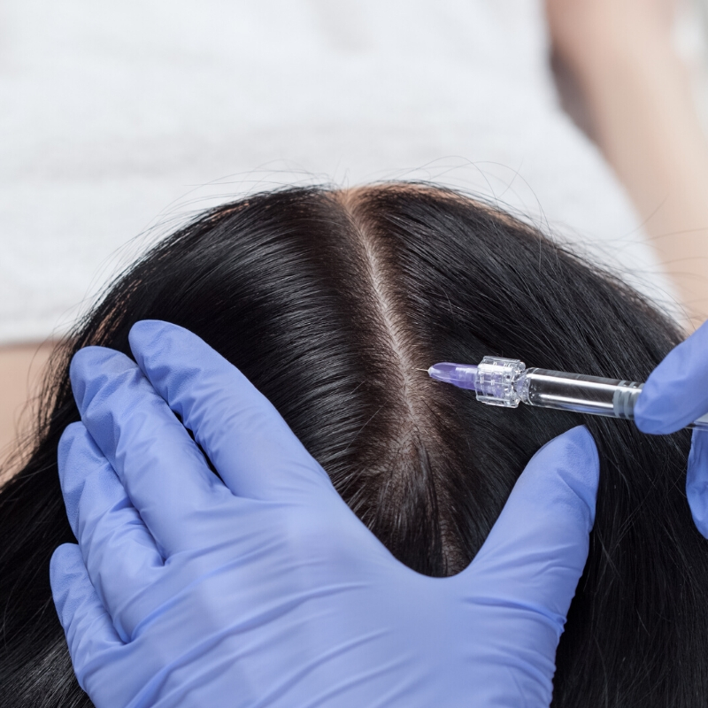 Steroid Injections in Alopecia Areata: Advice for the Primary Care  Practitioner and Other Physicians who Treat Alopecia — Donovan Hair Clinic