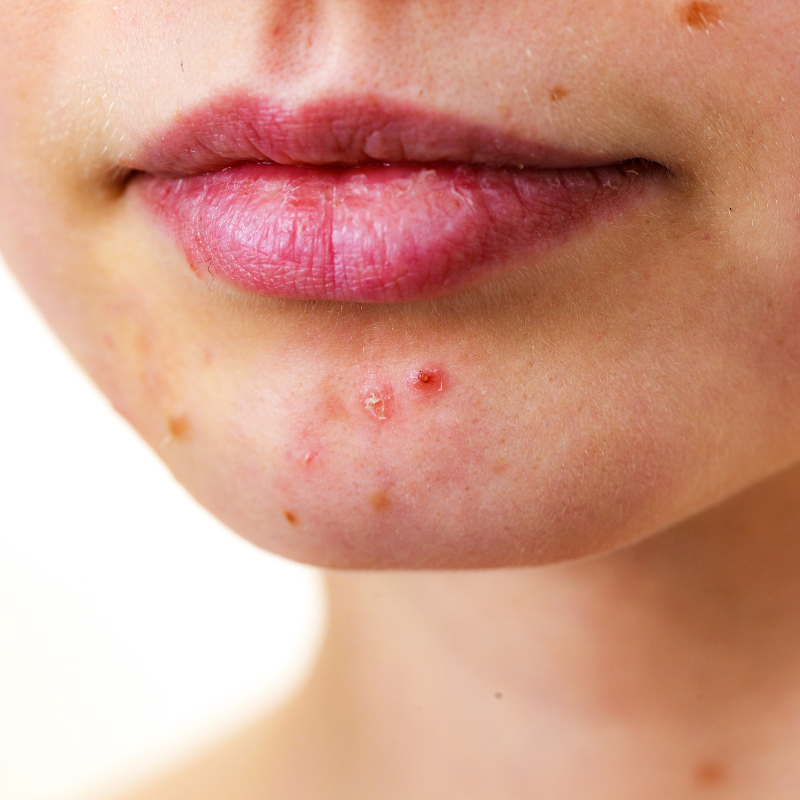 How to treat acne?