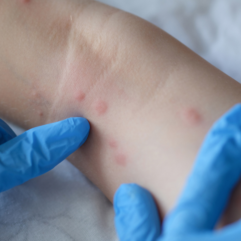 What are the symptoms of eczema?