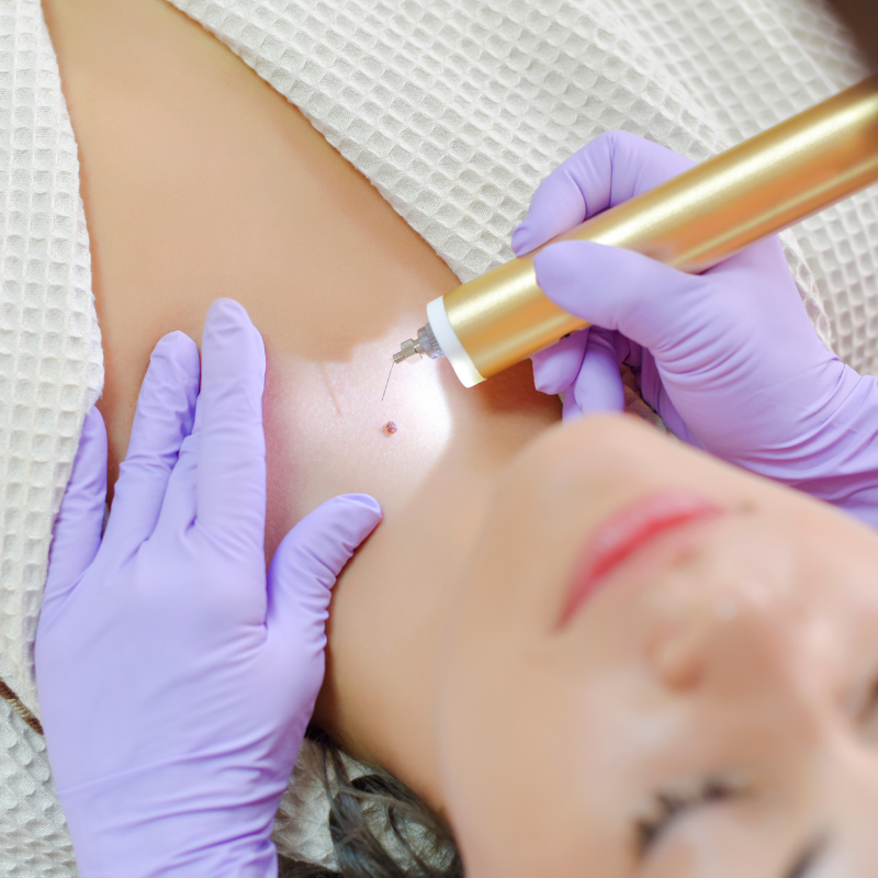 What is the cost of mole removal treatment in Bangalore?