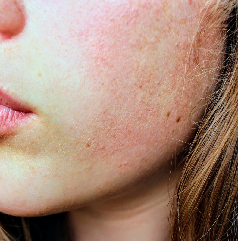How to get rid of acne? | Skin Specialist in Bangalore | Dr. Divya