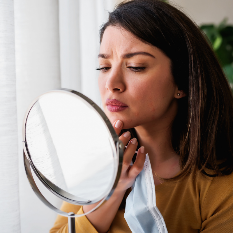 Does maskne require a consultation from a dermatologist?