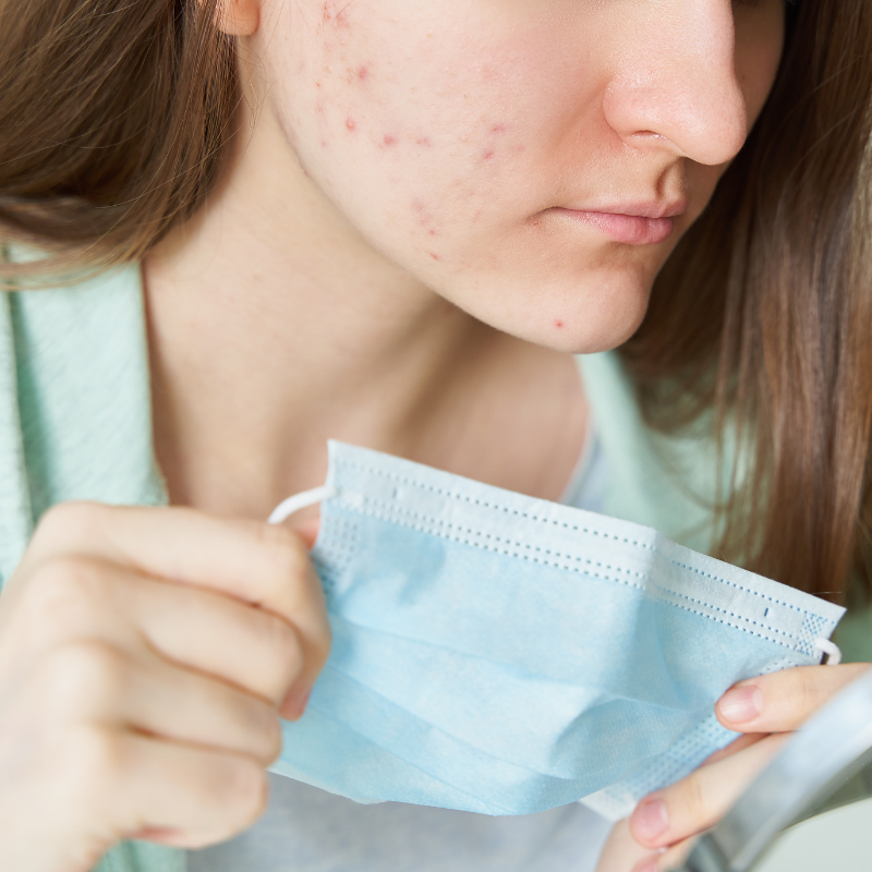 How can we avoid acne while continuing to wear masks?