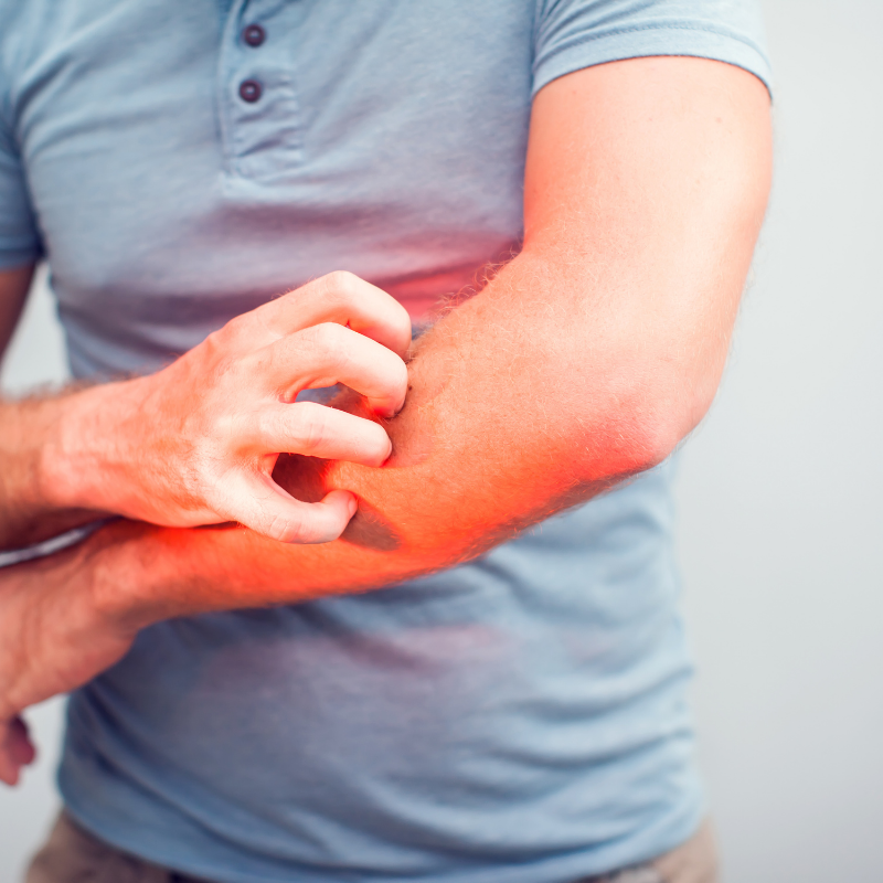 What are the symptoms of lichen planus?
