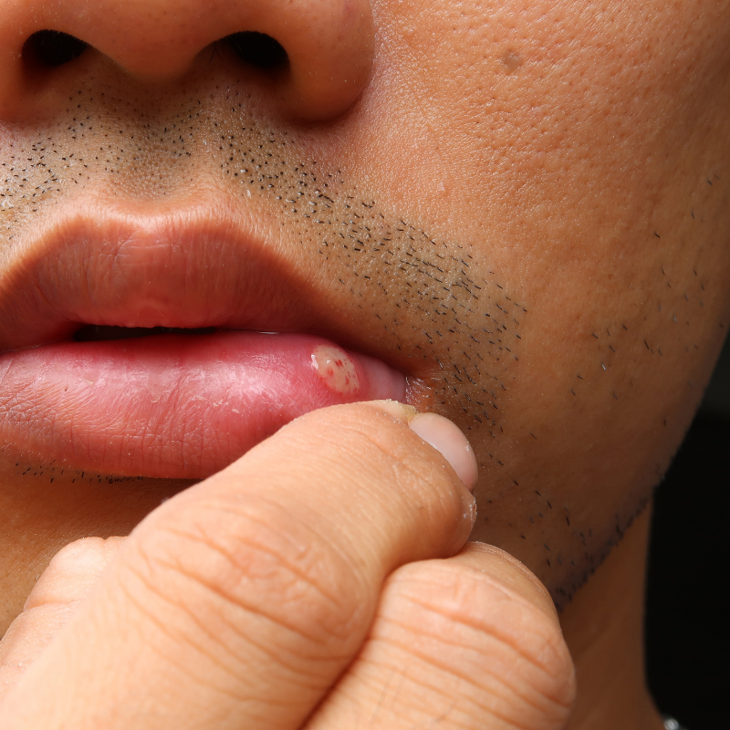 Why does lichen planus happen?